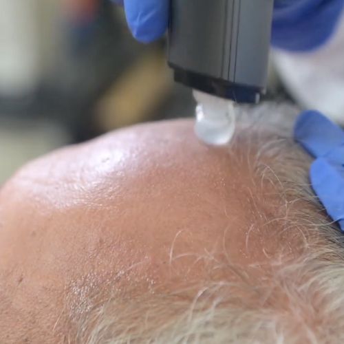 hair restoration st petersburg - juvasonic